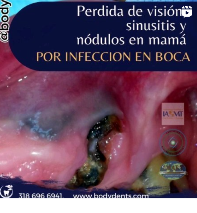 sinusitis por infeccion en boca